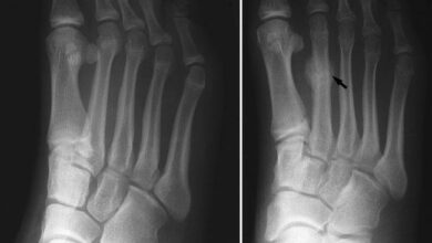 تصویر ایکس-ری ترک‌خوردگی در پا