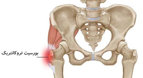 آناتومی لگن خاصره و بورسیت لگن (تروکانتریک)